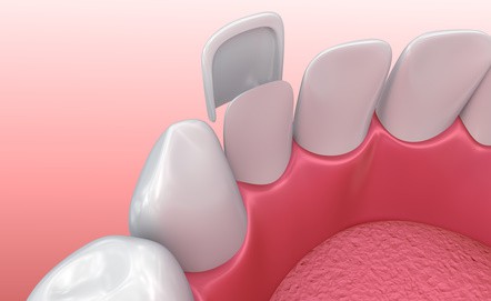 Zahn Veneers